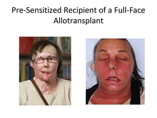 Pre-Sensitized Recipient of a Full-Face
Allotransplant
 