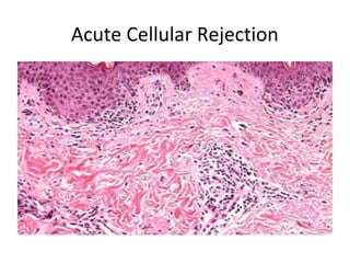 Acute Cellular Rejection
 