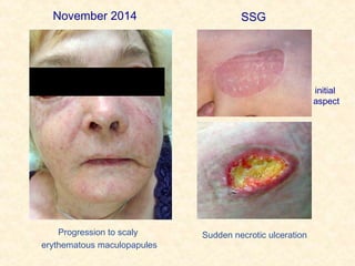 Sudden necrotic ulcerationProgression to scaly
erythematous maculopapules
SSG
initial
aspect
SSGNovember 2014
 