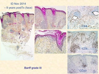 ID Nov 2014
– 9 years postTx (face)
CD20
CD4
C4d
Banff grade III
 