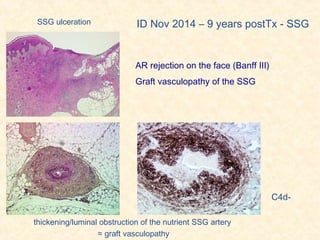 thickening/luminal obstruction of the nutrient SSG artery
≈ graft vasculopathy
SSG ulceration ID Nov 2014 – 9 years postTx - SSG
C4d-
AR rejection on the face (Banff III)
Graft vasculopathy of the SSG
 
