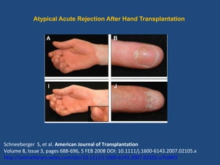 Atypical Acute Rejection After Hand Transplantation
Schneeberger S, et al. American Journal of Transplantation
Volume 8, Issue 3, pages 688-696, 5 FEB 2008 DOI: 10.1111/j.1600-6143.2007.02105.x
http://onlinelibrary.wiley.com/doi/10.1111/j.1600-6143.2007.02105.x/full#f3
 