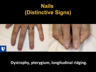 Nails
(Distinctive Signs)
Dystrophy, pterygium, longitudinal ridging.
 