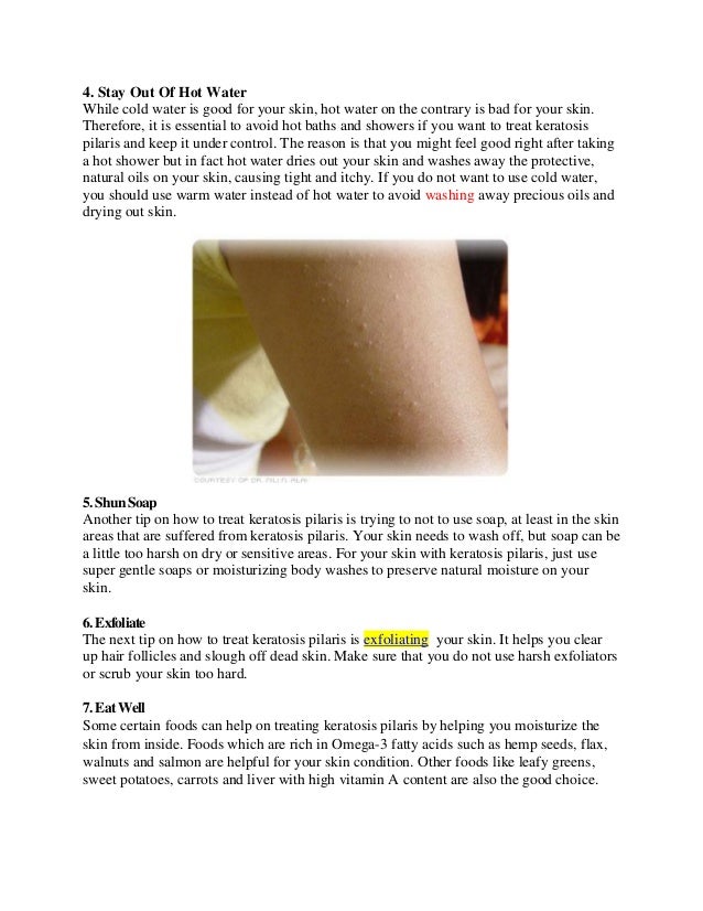 Learn How To Treat Keratosis Pilaris With 8 Tips And Tricks