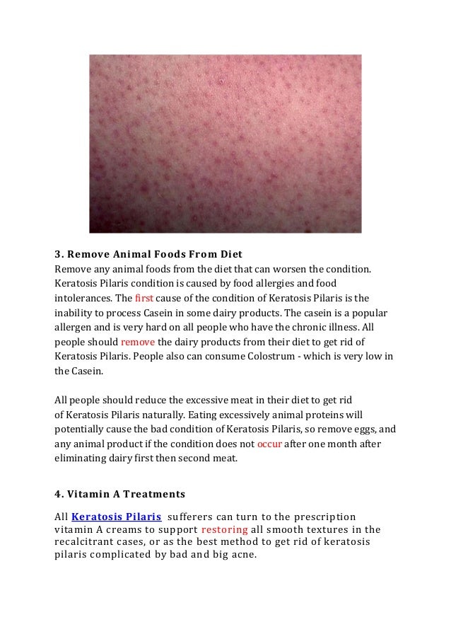 Tips To Get Rid Of Keratosis Pilaris With All Natural Ways