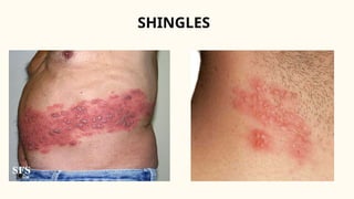 All information available from definition and treatment | PPTX