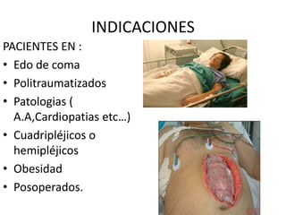 INDICACIONES
PACIENTES EN :
• Edo de coma
• Politraumatizados
• Patologias (
A.A,Cardiopatias etc…)
• Cuadripléjicos o
hemipléjicos
• Obesidad
• Posoperados.
 