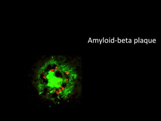 Amyloid-beta plaque 