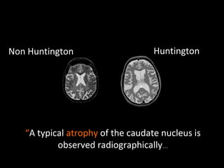 Non Huntington Huntington “ A typical  atrophy  of the caudate nucleus is observed radiographically … 