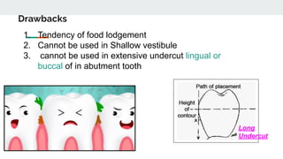 Drawbacks
1. Tendency of food lodgement
2. Cannot be used in Shallow vestibule
3. cannot be used in extensive undercut lingual or
buccal of in abutment tooth
Long
Undercut
 