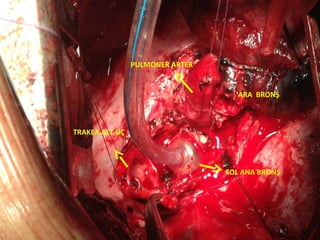 PULMONER ARTER


                                   ARA BRONŞ



TRAKEA ALT UÇ




                                 SOL ANA BRONŞ
 