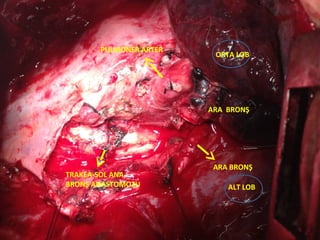 PULMONER ARTER
                         ORTA LOB




                        ARA BRONŞ




                         ARA BRONŞ
TRAKEA-SOL ANA
BRONŞ ANASTOMOZU            ALT LOB
 