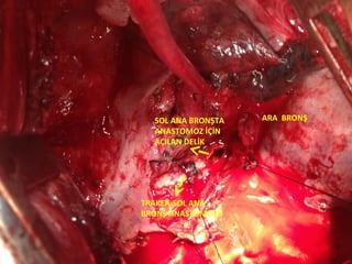 SOL ANA BRONŞTA   ARA BRONŞ
  ANASTOMOZ İÇİN
  AÇILAN DELİK




TRAKEA-SOL ANA
BRONŞ ANASTOMOZU
 
