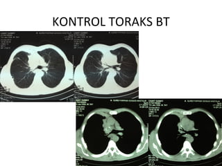 KONTROL TORAKS BT
 