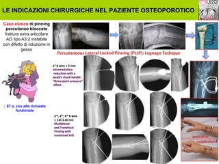LE INDICAZIONI CHIRURGICHE NEL PAZIENTE OSTEOPOROTICO
Caso clinico di pinning
percutaneo bloccato
frattura extra articolare
AO tipo A3.2 instabile
con difetto di riduzione in
gesso

♀ 67 a. con alta richiesta
funzionale

 