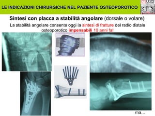 LE INDICAZIONI CHIRURGICHE NEL PAZIENTE OSTEOPOROTICO

Sintesi con placca a stabilità angolare (dorsale o volare)
La stabilità angolare consente oggi la sintesi di fratture del radio distale
osteoporotico impensabili 10 anni fa!

ma…

 