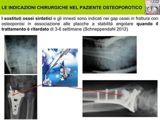LE INDICAZIONI CHIRURGICHE NEL PAZIENTE OSTEOPOROTICO
I sostituti ossei sintetici e gli innesti sono indicati nei gap ossei in frattura con
osteoporosi in associazione alle placche a stabilità angolare quando il
trattamento è ritardato di 3-6 settimane (Schneppendahl 2012)

 