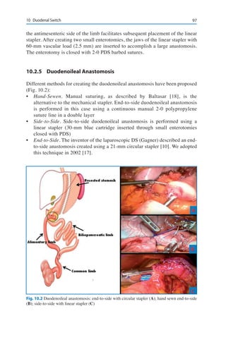 9710	 Duodenal Switch
the antimesenteric side of the limb facilitates subsequent placement of the linear
stapler. After creating two small enterotomies, the jaws of the linear stapler with
60-mm vascular load (2.5 mm) are inserted to accomplish a large anastomosis.
The enterotomy is closed with 2-0 PDS barbed sutures.
10.2.5	 Duodenoileal Anastomosis
Different methods for creating the duodenoileal anastomosis have been proposed
(Fig. 10.2):
•	 Hand-Sewen. Manual suturing, as described by Baltasar [18], is the
alternative to the mechanical stapler. End-to-side duodenoileal anastomosis
is performed in this case using a continuous manual 2-0 polypropylene
suture line in a double layer
•	 Side-to-Side. Side-to-side duodenoileal anastomosis is performed using a
linear stapler (30-mm blue cartridge inserted through small enterotomies
closed with PDS)
•	 End-to-Side. The inventor of the laparoscopic DS (Gagner) described an end-
to-side anastomosis created using a 21-mm circular stapler [10]. We adopted
this technique in 2002 [17].
Fig. 10.2 Duodenoileal anastomosis: end-to-side with circular stapler (A); hand sewn end-to-side
(B); side-to-side with linear stapler (C)
 
