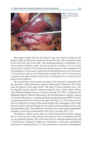 10911	 Single Anastomosis Duodenoileal Bypass with Sleeve Gastrectomy
The surgeon stands between the patient’s legs, the camera assistant on the
patient’s right, and the first assistant on the patient’s left. The scrub nurse stands
at the lower left side of the table. The pneumoperitoneum is established via a
Veress needle at Palmer’s point. Trocars are placed as follows: a 10- to 12-mm
camera trocar is placed ~20 cm below the xiphoid process a few centimeters left
of paramedian; a 5-mm trocar is placed in the subxiphoid area for liver retraction;
a 5-mm trocar is placed on the left anterior axillary line; a 10- to 12-mm trocar
is placed on the right anterior axillary line; an additional 10- to 12-mm trocar is
placed in the umbilicus.
Devascularization of the greater curvature of the stomach is performed with
the ultrasonic scalpel (Harmonic, Ethicon Endosurgery, Cincinnati, OH, USA)
from the pylorus to the angle of His. The sleeve is then calibrated over a 54-
Fr orogastric bougie and the stomach transected with a linear stapler (iDrive
Ultra Powered Stapling System, Covidien, Norwalk, CT, USA, or Echelon Flex
Endopath Staplers, Ethicon Endosurgery) 60-mm black/green cartridge, starting
3–4 cm from the pylorus. A running introflecting polydioxanone (PDS) 3-0 suture
is generally performed to reinforce the staple line (Fig. 11.1). The suture line can
also be reinforced by using reinforcement patches like Seamguard or Peri-Strip.
Dissection then continues through the first portion of the duodenum down to the
gastroduodenal artery. The duodenum is divided with a linear stapler (purple/blue
cartridge), preserving vascularization of the lesser curvature (Fig. 11.2).
The patient is placed, at this point, in a horizontal position and the surgeon
moves to the left side of the patient. The ileocecal valve is identified and 250
cm are measured upward. The small bowel loop is ascended antecolically and
a double-layer continuous handsewn isoperistaltic end-to-side duodenoileal
anastomosis is fashioned (Fig. 11.3). The anastomosis is tested for watertightness
Fig. 11.1 Final aspect
of the gastric resection
(sleeve)
 