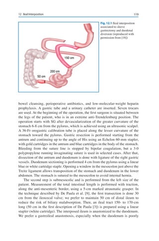 11912	 Ileal Interposition
bowel cleansing, perioperative antibiotics, and low-molecular-weight heparin
prophylaxis. A gastric tube and a urinary catheter are inserted. Seven trocars
are used. At the beginning of the operation, the first surgeon is situated between
the legs of the patient, who is in an extreme anti-Trendelenburg position. The
operation starts with SG after devascularization of the greater curvature of the
stomach 6-8 cm from the pylorus, which is achieved using an ultrasonic scalpel.
A 36-Fr orogastric calibration tube is placed along the lesser curvature of the
stomach toward the pylorus. Gastric resection is performed starting from the
antrum and continuing up to the angle of His using an Echelon 60-mm stapler,
with gold cartridges in the antrum and blue cartridges in the body of the stomach.
Bleeding from the suture line is stopped by bipolar coagulation, but a 3-0
polypropylene running invaginating suture is used in selected cases. After that,
dissection of the antrum and duodenum is done with ligature of the right gastric
vessels. Duodenum sectioning is performed 4 cm from the pylorus using a linear
blue or white cartridge staple. Opening a window in the mesocolon just above the
Treitz ligament allows transposition of the stomach and duodenum in the lower
abdomen. The stomach is sutured to the mesocolon to avoid internal hernia.
The second step is submesocolic and is performed from the left size of the
patient. Measurement of the total intestinal length is performed with traction,
along the anti-mesenteric border, using a 5-cm marked atraumatic grasper. In
the technique described by De Paula et al. [9], the first transection is done 30
cm from the ileocecal valve; we prefer to maintain 50 cm of distal ileum to
reduce the risk of biliary malabsorption. Then, an ileal tract 150- to 170-cm
long (50 cm in the first description of De Paula [3]) is prepared using a linear
stapler (white cartridge). The interposed ileum is anastomized to the duodenum.
We prefer a gastroileal anastomosis, especially when the duodenum is poorly
Fig. 12.1 Ileal interposition
associated to sleeve
gastrectomy and duodenal
diversion (reproduced with
permission from [16])
 