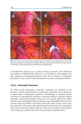 158 D. Tassinari et al.
a nonadjustable silicone ring, or pouch resizing represents valid indications
for treatment of RYGB failure. However, it is essential to select patients only
after adequate psychiatric/psychological study and in relation to endoscopic
procedures, X-rays, and CT with oral contrast, to be able to document dilation.
16.4.2	 Endoscopic Treatment
To reduce pouch dimensions, endoscopic treatments are indicated in the
presence of gastric pouch dilation or gastroenteric anastomosis as an alternative
to laparoscopic or laparotomic operations. Sclerotherapy is intended increase
restriction by endoscopically injecting a sclerosing substance, generally sodium
morrhuate, at the perianastomotic tissue level or at gastric pouch level. Other
methods, such as the Bard EndoCinch suturing system, StomaphyX, Rose, Ovesco
over-the-scope clip (OTSC), and Apollo endoscopic suture system, aim to carry
out a plication of the gastric wall, reducing pouch dimensions and in compliance
with various fastening methods. However, there are no studies in the literature
with a long-term evaluation of results of the procedures described above.
Fig. 16.1 Pouch resizing and Fobi ring placement: A Isolation and mobilization of the gastric
pouch and anastomotic gastrojejunal complex. B Vertical gastrectomy using linear stapler along a
36-Fr bougie. C Resized gastric pouch. D Silicone ring placement
 