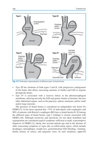 166 P. Iovino et al.
•	 Type III has elements of both types I and II, with progressive enlargement
of the hiatus that allows increasing amounts of fundus and LES to migrate
through the hiatus.
•	 Type IV is associated with a massive defect in the phrenoesophageal
membrane, allowing not only the LES and gastric fundus to herniate, but also
other abdominal organs, such as the pancreas, spleen, omentum, and/or small
and/or large intestine.
The presence of hiatal hernia is considered an independent risk factor for
GERD [7]. It has been reported that ~75% of individuals with esophagitis and
90% of patients with Barrett’s esophagus (BE) have a hiatal hernia [8, 9] Among
the different types of hiatal hernia, type I (sliding) is closely associated with
GERD [10]. Although sensitivity and specificity are not ideal, heartburn and
regurgitation are considered typical symptoms sufficient to make a presumptive
diagnosis of GERD [1], taking into account patient age and in the absence of
other concerning symptoms or signs (the so-called alarm signs), which include
dysphagia, odynophagia, weight loss, gastrointestinal (GI) bleeding, vomiting,
family history of cancer, and epigastric mass. In such situations, upper-GI
Esophagus
Esophagogastric
junction
Diaphragm
Stomach
Herniated
Stomach
Type I
Type II
Type III
Type IV
Diaphragm
Diaphragm Diaphragm
Herniated
Stomach
Herniated
Stomach
Stomach
Stomach
Esophago-
gastric
junction
Esophago-
gastric
junction
Esophago-
gastric
junction
Esophagus
Esophagus
Esophagus
Herniated
Stomach
Herniated
transverse
colon
Transverse colon Omentum
Fig. 17.1 Schematic representation of different types of hiatal hernia
 