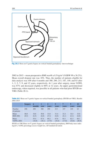200 M. Lucchese et al.
2002 to 2015 – mean preoperative BMI was48 ± 8.5 kg/m2
(%EBW 99 ± 36.2%).
Mean overall dropout rate was 10%. Thus, the number of patients eligible for
data analysis was 450 after 6 months and 380, 290, 213, 187, 149, and 63 after
1, 2, 5, 7, 9, and 12 years, respectively. At 1 year after surgery, mean %EWL
was 67% and decreased slightly to 60% at 12 years. An upper gastrointestinal
endoscopy, when required, was possible in all patients who had prior RYGB-on-
VBG (Table 20.1).
Fig. 20.2: Roux-en-Y gastric bypass on vertical banded gastroplasty: latest technique
Table 20.1 Roux-en-Y gastric bypass on vertical banded gastroplasty (RYGB-on-VBG). Results
2002-2015
	 Surgery	6	1	2	5	7	9	12
		 months 	year	years	years	years	years	years
Number 	 456	 450	380	290	213	187	149	63
of patients
Mean 	 48.0	 34.8	30.8	31.0	31.4	32.3	32.5	33.0
BMI (SD)	 (8.5)	 (6.5)	(6.0)	(5.3)	(6.0)	(6.1)	(6.1)	(6.0)
Mean 	 –	 55.4	67.4	69.2	67.8	65.1	62.3	60.1
%EWL (SD)		 (16.8)	(18.1)	(17.9)	(18.4)	(17.8)	(16.6)	(20.5)
RYGB-on-VBG Roux-en-Y gastric bypass on vertical banded gastroplasty, BMI body mass index
(kg/m2
), %EWL percentage excess weight loss, SD standard deviation
Gastric pouch
Gastric division
PTFE band
Bypassed stomach
Bypassed duodenum
Alimentary
loop
150 cm
 