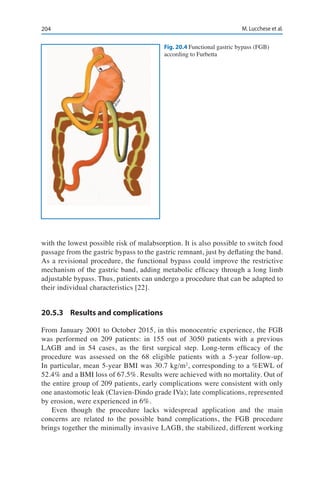 204 M. Lucchese et al.
with the lowest possible risk of malabsorption. It is also possible to switch food
passage from the gastric bypass to the gastric remnant, just by deflating the band.
As a revisional procedure, the functional bypass could improve the restrictive
mechanism of the gastric band, adding metabolic efficacy through a long limb
adjustable bypass. Thus, patients can undergo a procedure that can be adapted to
their individual characteristics [22].
20.5.3	 Results and complications
From January 2001 to October 2015, in this monocentric experience, the FGB
was performed on 209 patients: in 155 out of 3050 patients with a previous
LAGB and in 54 cases, as the first surgical step. Long-term efficacy of the
procedure was assessed on the 68 eligible patients with a 5-year follow-up.
In particular, mean 5-year BMI was 30.7 kg/m2
, corresponding to a %EWL of
52.4% and a BMI loss of 67.5%. Results were achieved with no mortality. Out of
the entire group of 209 patients, early complications were consistent with only
one anastomotic leak (Clavien-Dindo grade IVa); late complications, represented
by erosion, were experienced in 6%.
Even though the procedure lacks widespread application and the main
concerns are related to the possible band complications, the FGB procedure
brings together the minimally invasive LAGB, the stabilized, different working
Fig. 20.4 Functional gastric bypass (FGB)
according to Furbetta
 