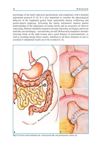 32 M. De Luca et al.
knowledge of the band’s physical specifications and compliance with a detailed
adjustment protocol [1–4]. It is also important to consider the physiological
behavior of the implanted gastric band, particularly during swallowing and
gastric-pouch emptying. Activating the satiety mechanism requires patient
understanding of the importance of eating slowly and an awareness of when to
stop eating. Patients should be trained to eat only when they are hungry and to eat
until they are not hungry – not until they are full. Behavioral compliance includes
choosing foods of the right texture and a good balance of macronutrients, as
well as avoiding energy-dense snacks. Attention to all these elements of care is
essential if suboptimal results are to be avoided [4, 5].
Fig. 5.1 Gastric band implanted (a), virtual pouch (b), and gastrogastric sutures (c)
a c
b
 