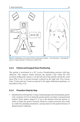 436	 Sleeve Gastrectomy
6.2.2	 Patient and Surgical Team Positioning
The patient is positioned in a 30° reverse Trendelenburg position with legs
abducted. The surgeon stands between the patient’s legs while the first
assistant, holding the camera, is on the left side of the patient, beside the scrub
nurse (Fig. 6.1a). A second assistant is placed on the right side. Five trocars
(four 12-mm and one 5-mm) are placed in the upper abdominal quadrants, as
described in Fig. 6.1b.
6.2.3	 Procedure Step by Step
•	 Identification of the pylorus: Using a marked grasper and stretching the gastric
wall, a distance of 4–6 cm along the greater gastric curvature is measured and
marked. Some authors suggest 2–3 cm as the distance from the pylorus as
where to begin the gastric resection. However, antrum resection may result
in a defective pumping mechanism, causing nausea to the patient because of
delayed gastric emptying.
a b
Fig. 6.1 a Operating room setup. b Trocar placement scheme. 1 left subcostal, 2 subxyphoid, 3
optical, 4 right subcostal, 5 left anterior axillary line
 
