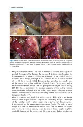 456	 Sleeve Gastrectomy
•	 Orogastric tube insertion: This tube is inserted by the anesthesiologist and
pushed down, possibly through the pylorus. It is then placed against the
lesser curvature in order to calibrate the resection. In our clinical practice,
we use a 48-Fr bougie, although in the literature the use of tube sizes from
30- to 60-Fr is reported [13]. Literature data correlate the smaller size
of the bougie to a higher incidence of gastric leaks. Furthermore, a clear
relationship between bougie size and postoperative weight loss is lacking
[14–18]. In our experience, the residual capacity of the gastric remnant
does not depend on bougie size but mainly on the degree of countertraction
exerted on the stomach walls when resecting and on accurate dissection of
the gastric fundus [19].
•	 Gastric resection and staple-line reinforcement: This step is performed
using a linear stapler applied alongside the calibrating bougie. The height
of the cartridges must be chosen according to gastric-wall thickness, since
it decreases from the antrum to the corpus and fundus. We prefer a staple
height of 4.4 or 4.1 mm near the antrum and 3.8 or 3.5 mm on the corpus
and fundus. In revision surgery cases, the use of higher staples might be
advisable because of the presence of thick scar tissue. Before closing and
a
c
b
d
Fig. 6.2 a Dissection of the gastric fundus from the anterior aspect of the left pillar. b Left gastric
vessels are visualized together with the left pillar. c Enlarged hiatus. d Posterior hiatoplasty with
nonabsorbable stitches. LP left pillar, GF gastric fundus, LGV left gastric vessels, VN vagus nerve,
RP right pillar
 