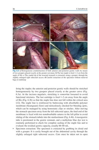 46 E. Soricelli et al.
firing the stapler, the anterior and posterior gastric walls should be stretched
homogeneously by two graspers placed exactly at the greater curve (Fig.
6.3a). At the incisura angularis, stretching is somewhat loosened to avoid
functional strictures. The last cartridge is fired 1–2 cm away from the angle
of His (Fig. 6.3b) so that the staple line does not fall within the critical area
[12]. The staple line is reinforced by buttressing with absorbable polymer
membrane (Seamguard, Gore) and meticulously checked for bleeding spots,
which can be managed by using hemostatic clips or stitches. After moving
the stomach specimen away from the left subcostal space, the final end of the
membrane is fixed with two nonabsorbable sutures to the left pillar to avoid
sliding of the stomach tubule into the mediastinum (Fig. 6.4b). A nasogastric
tube is positioned in the gastric remnant, and a methylene blue dye test is
routinely performed to check for complete sealing of the staple line and to
evaluate the residual gastric capacity, usually 60–80 mL.
•	 Specimen extraction: The specimen is extracted by grabbing its distal end
with a grasper. It is easily brought out of the abdominal cavity through the
slightly enlarged right subcostal access. Care must be taken not to open
Fig. 6.3 a Homogeneous countertraction of both anterior and posterior gastric walls by means
of two graspers placed exactly at the greater curvature. b The last staple is fired 1–2 cm from the
angle of His. c The caudal tip of the resected stomach is extracted, using a grasper, through the
slightly enlarged right subcostal access. d Careful extraction of the specimen without retrieval
bags or endoloop
a
c
b
d
 
