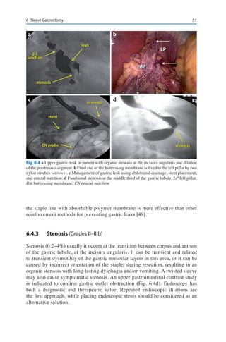 516	 Sleeve Gastrectomy
the staple line with absorbable polymer membrane is more effective than other
reinforcement methods for preventing gastric leaks [49].
6.4.3	Stenosis (Grades II–IIIb)
Stenosis (0.2–4%) usually it occurs at the transition between corpus and antrum
of the gastric tubule, at the incisura angularis. It can be transient and related
to transient dysmotility of the gastric muscular layers in this area, or it can be
caused by incorrect orientation of the stapler during resection, resulting in an
organic stenosis with long-lasting dysphagia and/or vomiting. A twisted sleeve
may also cause symptomatic stenosis. An upper gastrointestinal contrast study
is indicated to confirm gastric outlet obstruction (Fig. 6.4d). Endoscopy has
both a diagnostic and therapeutic value. Repeated endoscopic dilations are
the first approach, while placing endoscopic stents should be considered as an
alternative solution.
Fig. 6.4 a Upper gastric leak in patient with organic stenosis at the incisura angularis and dilation
of the prestenosis segment. b Final end of the buttressing membrane is fixed to the left pillar by two
nylon stitches (arrows). c Management of gastric leak using abdominal drainage, stent placement,
and enteral nutrition. d Functional stenosis at the middle third of the gastric tubule. LP left pillar,
BM buttressing membrane, EN enteral nutrition
a
c
b
d
 