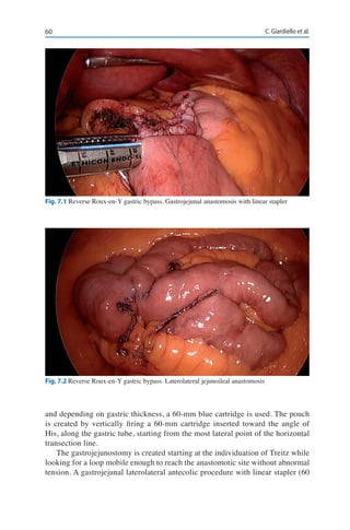 60 C. Giardiello et al.
and depending on gastric thickness, a 60-mm blue cartridge is used. The pouch
is created by vertically firing a 60-mm cartridge inserted toward the angle of
His, along the gastric tube, starting from the most lateral point of the horizontal
transection line.
The gastrojejunostomy is created starting at the individuation of Treitz while
looking for a loop mobile enough to reach the anastomotic site without abnormal
tension. A gastrojejunal laterolateral antecolic procedure with linear stapler (60
Fig. 7.1 Reverse Roux-en-Y gastric bypass. Gastrojejunal anastomosis with linear stapler
Fig. 7.2 Reverse Roux-en-Y gastric bypass. Laterolateral jejunoileal anastomosis
 
