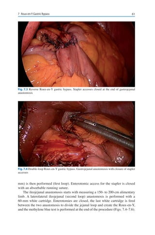 617	 Roux-en-Y Gastric Bypass
mm) is then performed (first loop). Enterotomic access for the stapler is closed
with an absorbable running suture.
The ileojejunal anastomosis starts with measuring a 150- to 200-cm alimentary
limb. A laterolateral ileojejunal (second loop) anastomosis is performed with a
60-mm white cartridge. Enterotomies are closed, the last white cartridge is fired
between the two anastomosis to divide the jejunal loop and create the Roux-en-Y,
and the methylene blue test is performed at the end of the procedure (Figs. 7.4–7.6).
Fig. 7.3 Reverse Roux-en-Y gastric bypass. Stapler accesses closed at the end of gastrojejunal
anastomosis
Fig. 7.4 Double-loop Roux-en-Y gastric bypass. Gastrojejunal anastomosis with closure of stapler
accesses
 