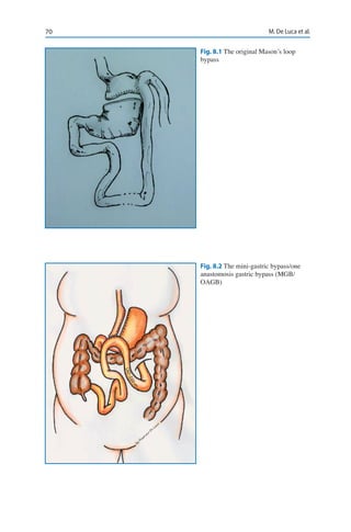 70 M. De Luca et al.
Fig. 8.1 The original Mason’s loop
bypass
Fig. 8.2 The mini-gastric bypass/one
anastomosis gastric bypass (MGB/
OAGB)
 