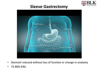Sleeve Gastrectomy
• Stomach reduced without loss of function or change in anatomy
• 75-80% EWL
 