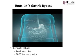 Roux-en-Y Gastric Bypass
• General Features
– Pouch size: 1 oz
– 70-80 % of excess weight
 