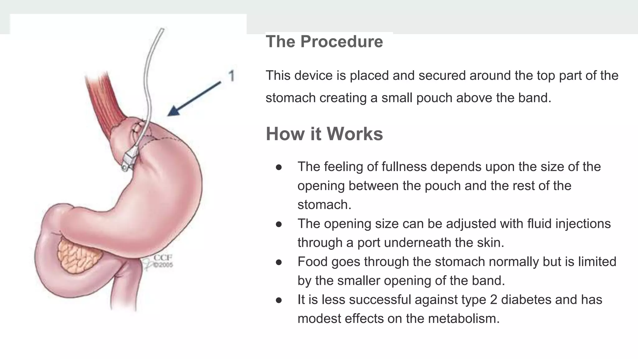Bariatric Surgery (1).pptx