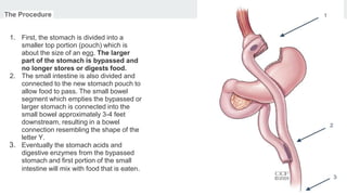 The Procedure
1. First, the stomach is divided into a
smaller top portion (pouch) which is
about the size of an egg. The larger
part of the stomach is bypassed and
no longer stores or digests food.
2. The small intestine is also divided and
connected to the new stomach pouch to
allow food to pass. The small bowel
segment which empties the bypassed or
larger stomach is connected into the
small bowel approximately 3-4 feet
downstream, resulting in a bowel
connection resembling the shape of the
letter Y.
3. Eventually the stomach acids and
digestive enzymes from the bypassed
stomach and first portion of the small
intestine will mix with food that is eaten.
 