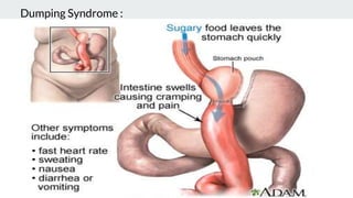 Dumping Syndrome :
 