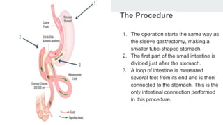 The Procedure
1. The operation starts the same way as
the sleeve gastrectomy, making a
smaller tube-shaped stomach.
2. The first part of the small intestine is
divided just after the stomach.
3. A loop of intestine is measured
several feet from its end and is then
connected to the stomach. This is the
only intestinal connection performed
in this procedure.
 