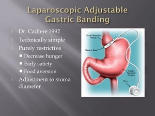  Dr. Cadiere 1992
 Technically simple
 Purely restrictive
 Decrease hunger
 Early satiety
 Food aversion
 Adjustment to stoma
diameter
 