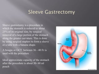 Sleeve gastrectomy is a procedure in
which the stomach is reduced to about
25% of its original size, by surgical
removal of a large portion of the stomach
along the greater curvature. This is done
by using surgical staplers to form a sleeve
or a tube with a banana shape.
A bougie or GCT between 36 - 40 Fr is
used with the procedure .
Ideal approximate capacity of the stomach
after the procedure is about 30- 60 ml
pouch
Sleeve Gastrectomy
 