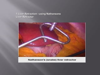 1.1.Liver Retraction –using NathansonsLiver Retraction –using Nathansons
Liver RetractorLiver Retractor
 