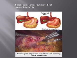 1.1.Gastrolysis of greater curvature- distalGastrolysis of greater curvature- distal
to prox. Upto> of His.to prox. Upto> of His.
 