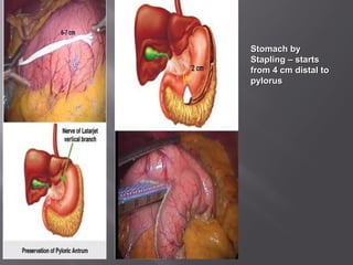 1.1.Resection ofResection of
Stomach byStomach by
Stapling – startsStapling – starts
from 4 cm distal tofrom 4 cm distal to
pyloruspylorus
 