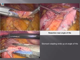 Stomach stapling ends up at angle of His
 