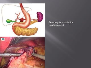 Suturing for staple lineSuturing for staple line
reinforcementreinforcement
 