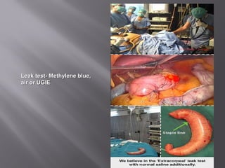 Leak test- Methylene blue,Leak test- Methylene blue,
air or UGIEair or UGIE
 